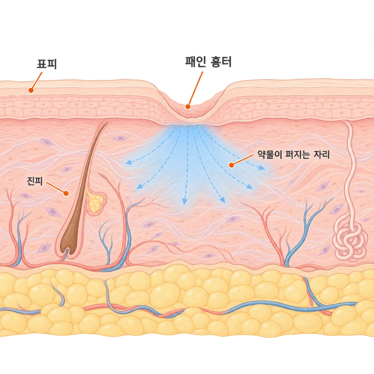 바늘 없이 압력으로 흉터 아래 진피에 약물을 퍼뜨려요