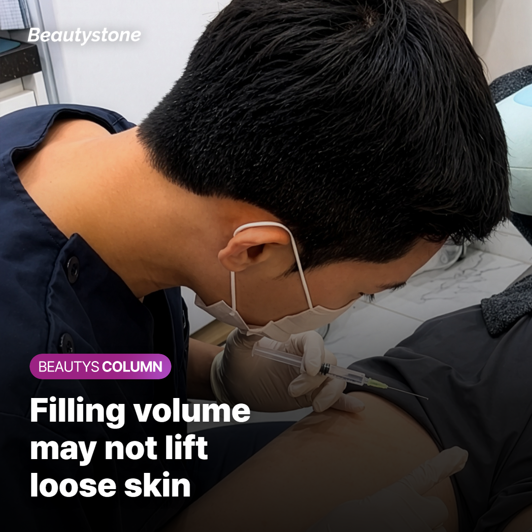 Cheek filler adding volume without pulling the skin toward the nasolabial fold