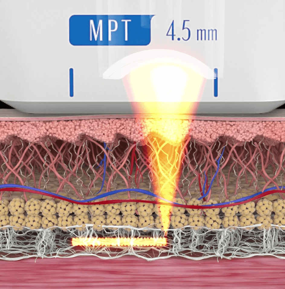 超声刀與Shurink效果差異比較