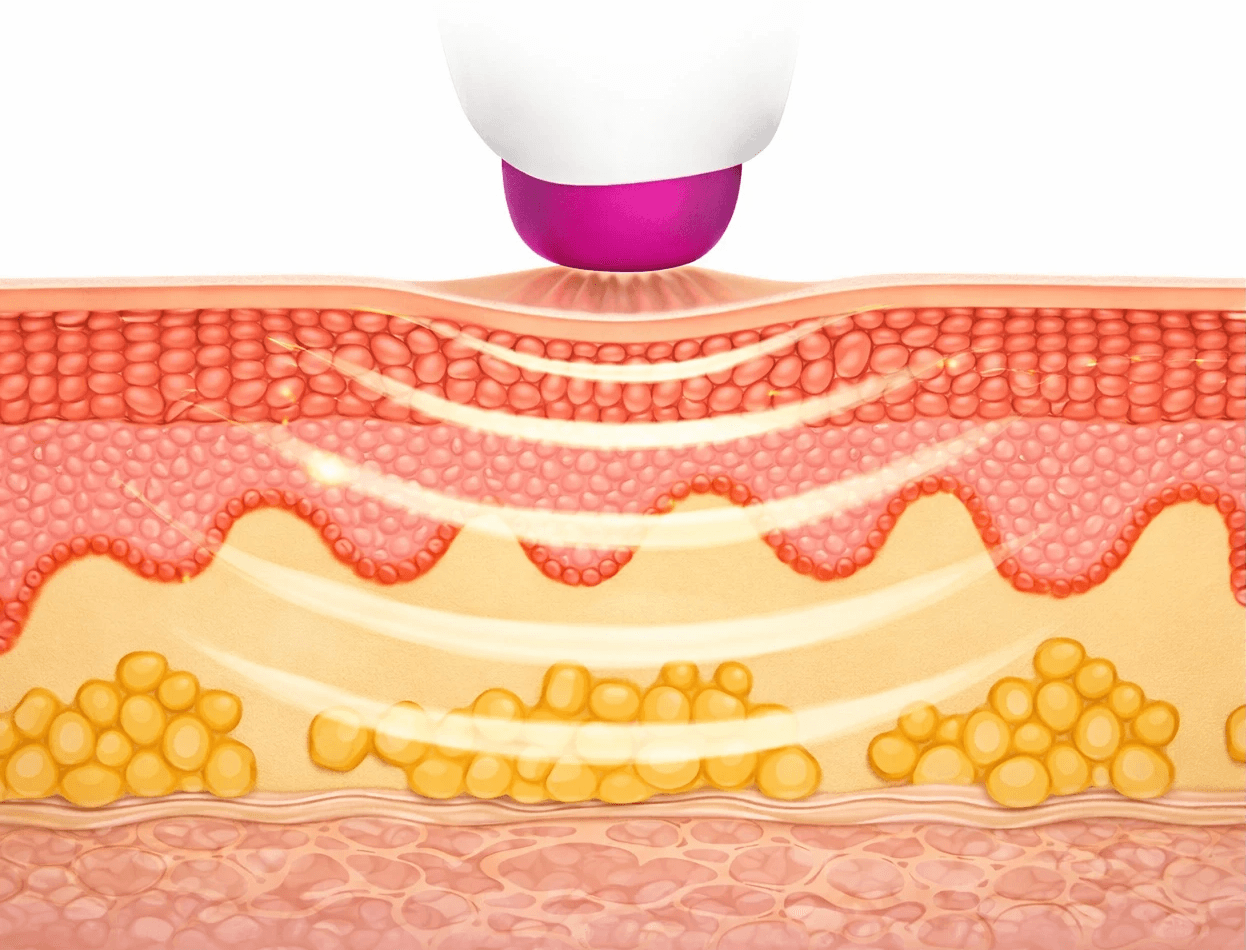熱玛吉FLX效果、持續時間，300發夠用嗎？