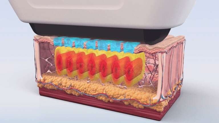 Who Benefits Most from Sofwave? Sofwave with No Worry About Cheek Volume Loss