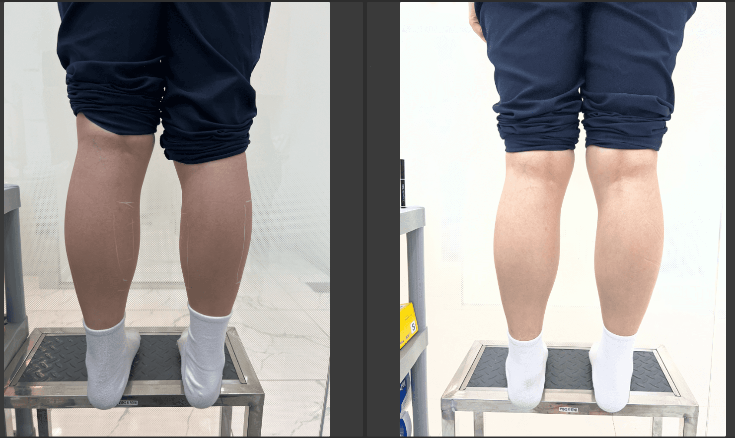 종아리 보톡스 후 효과와 주기, 종아리보톡스후기