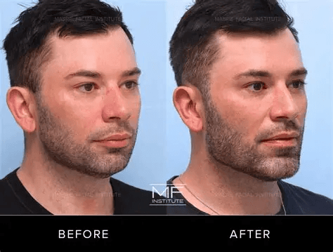 볼꺼짐 걱정 없는 남자 울쎄라 시술법, 여성과 시술 방식이 달라야 하는 이유